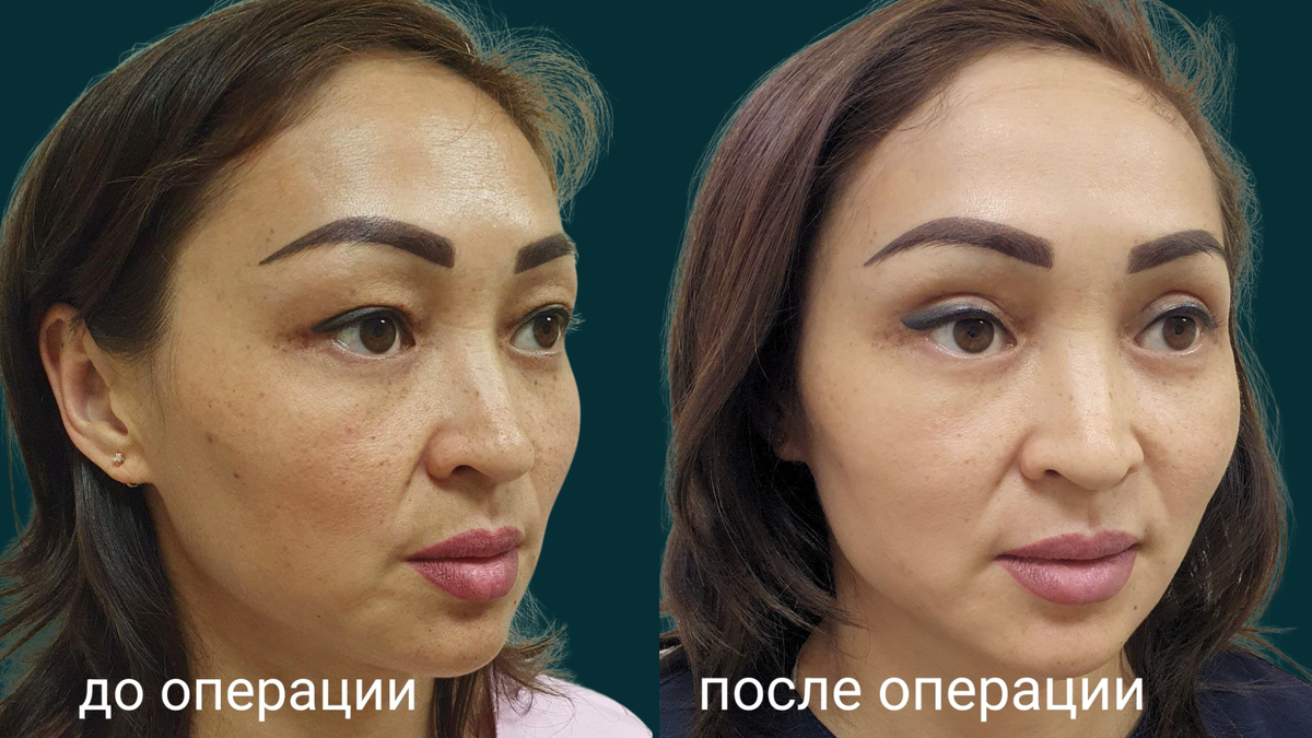 Кейс "До/ После": Бориса Владимировича Выступца, к.м.н., пластического хирурга