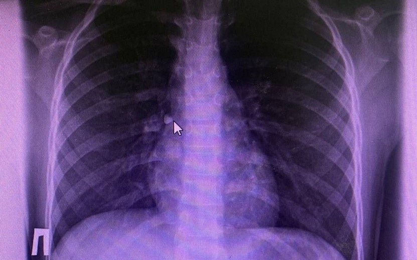    Вдохнувшую зуб девочку спасли врачи в Ижевске