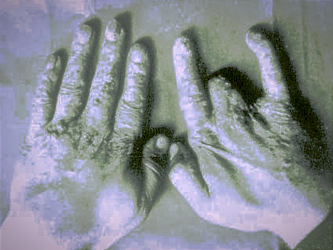 Руки человека из ЧАЭС, больного острой лучевой болезнью.