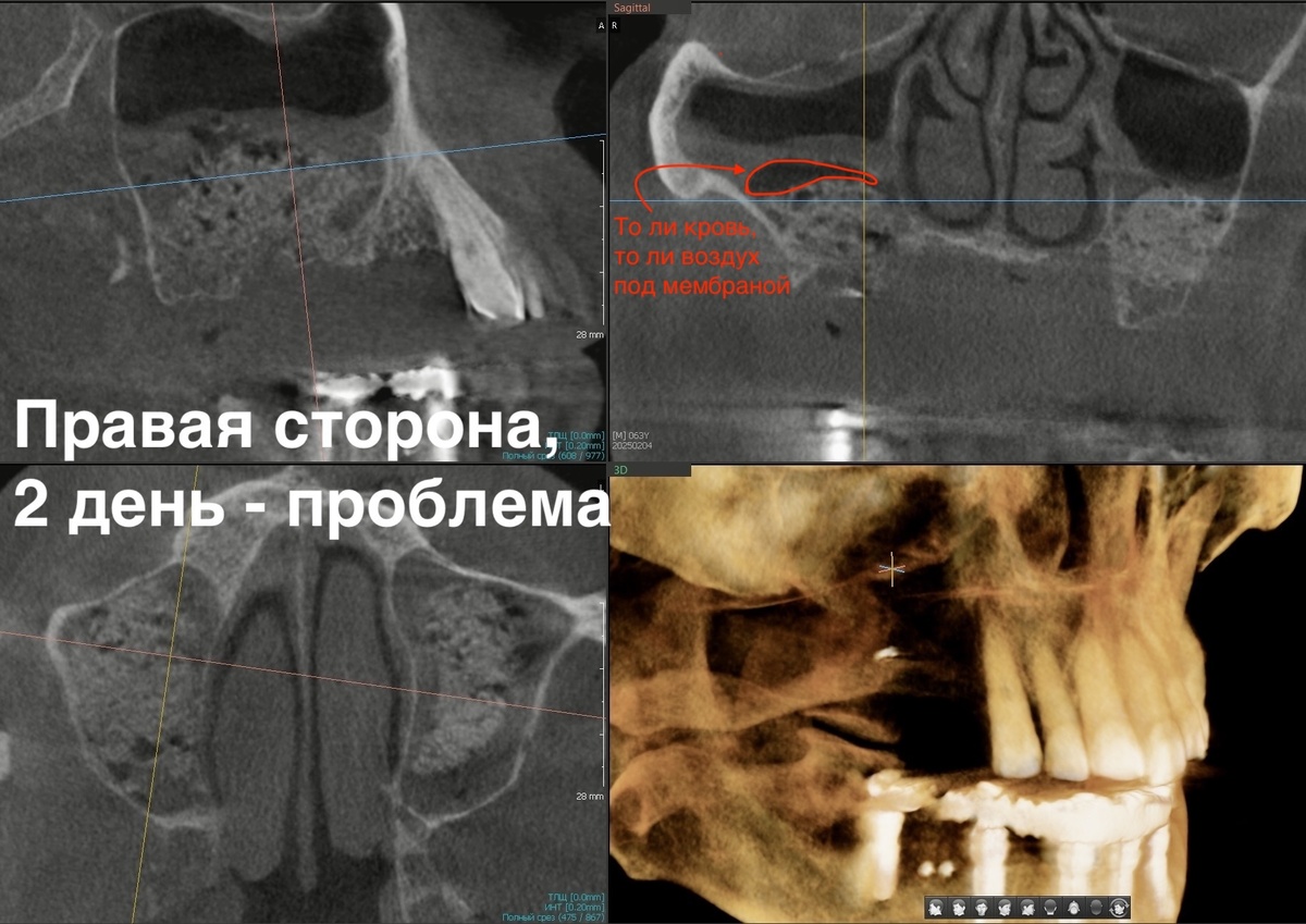 Оложнение синус-лифтинга, день второй