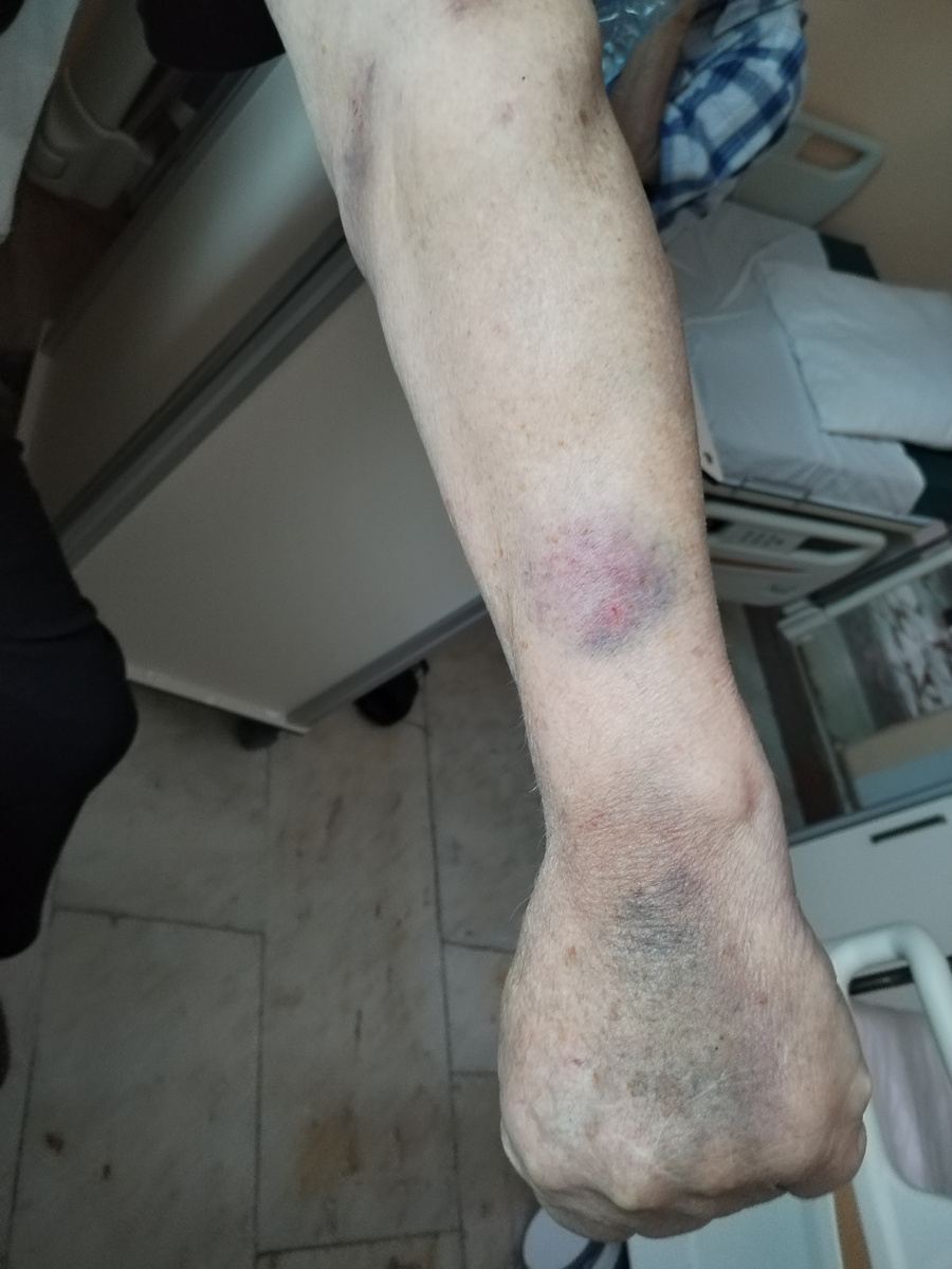 Следы от капельницы