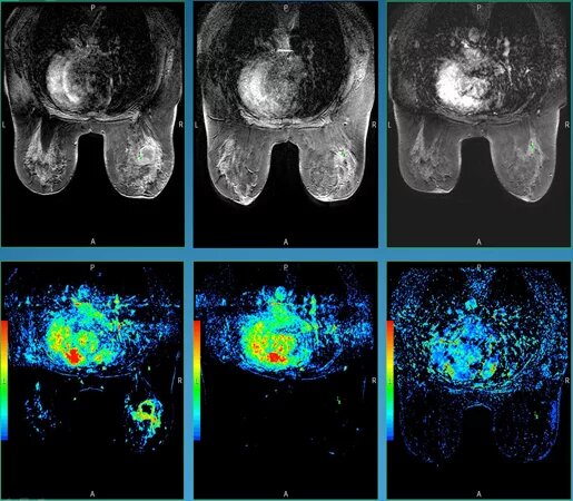 источник: https://breast-surgery.ru/mrt-molochnykh-zhelez
