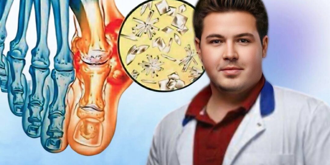 Подагра и камни в почках: что ожидать при высоком уровне мочевой кислоты и 5 способов его снижения