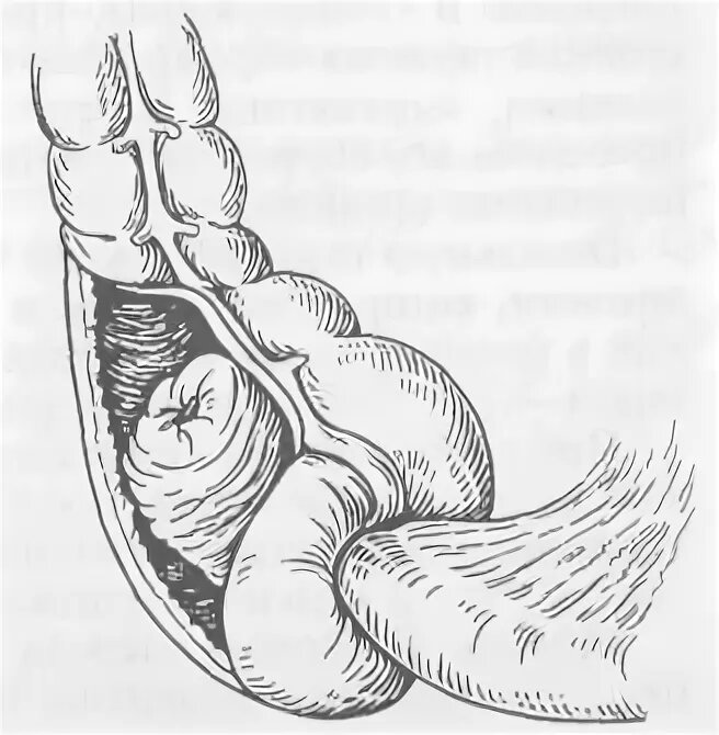 рис.1. Тонко-толстокишечная инвагинация