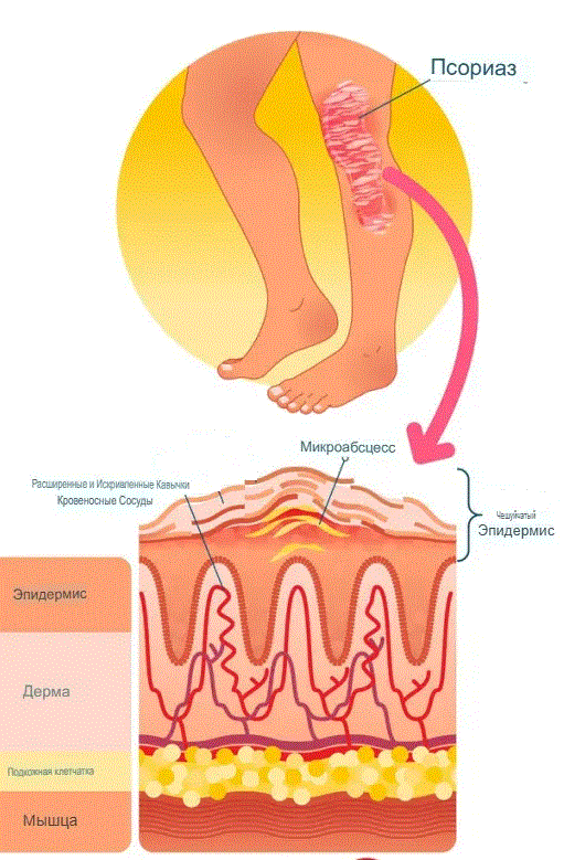 Псориаз — это хроническое аутоиммунное заболевание кожи, которое поражает около 2–3% населения мира. Псориаз характеризуется появлением красных воспаленных пятен и чешуйчатых бляшек на коже. Это связано с ускоренным делением клеток кожи: в норме клетки эпидермиса обновляются каждые 28 дней, при псориазе этот процесс может занимать всего 3–4 дня. В результате мертвые клетки накапливаются на поверхности кожи, вызывая шелушение и образование характерных бляшек.
