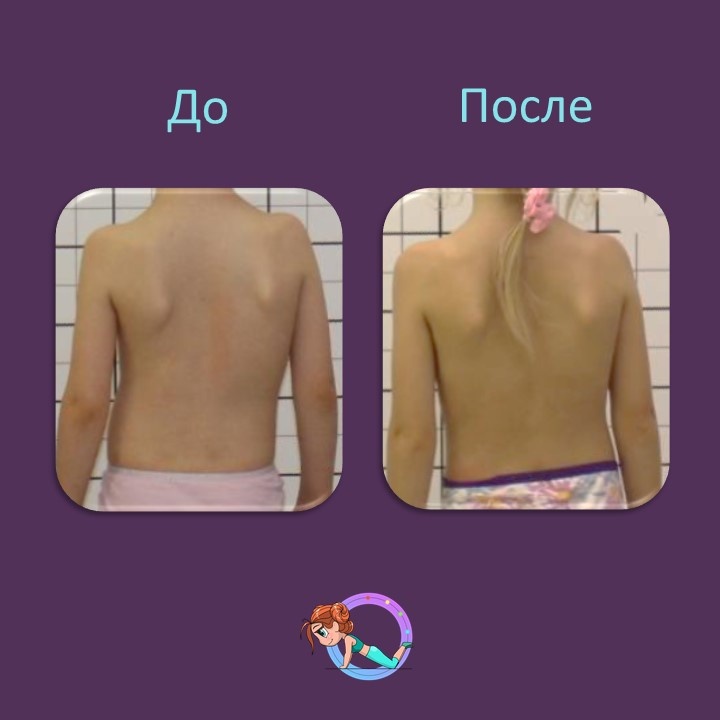 Пациентка З. 2016 г.р. обратилась на приём к врачу ортопеду к.м.н. Шавырину И.А. с жалобами на деформацию позвоночника.🩻 При осмотре поставлен диагноз: юношеский идиопатический сколиоз третьей степени. Было пройдено лечение: корсетотерапия по методу Шено и гимнастика Шрот.✅ На сегодняшний момент в корсете Шено угол деформации уменьшен с 32 до 12 градусов.👏 Коррекция в корсете 60%. Так же получен хороший косметический результат.🔥