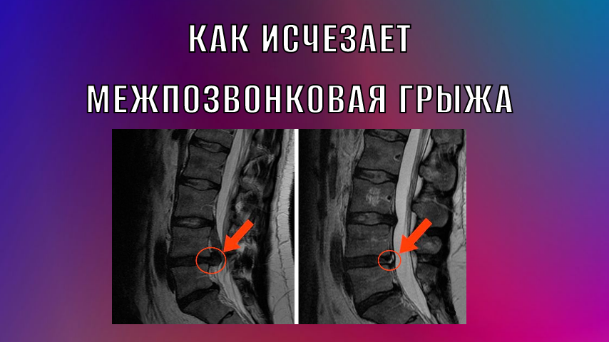 На МРТ нашли межпозвонковую грыжу