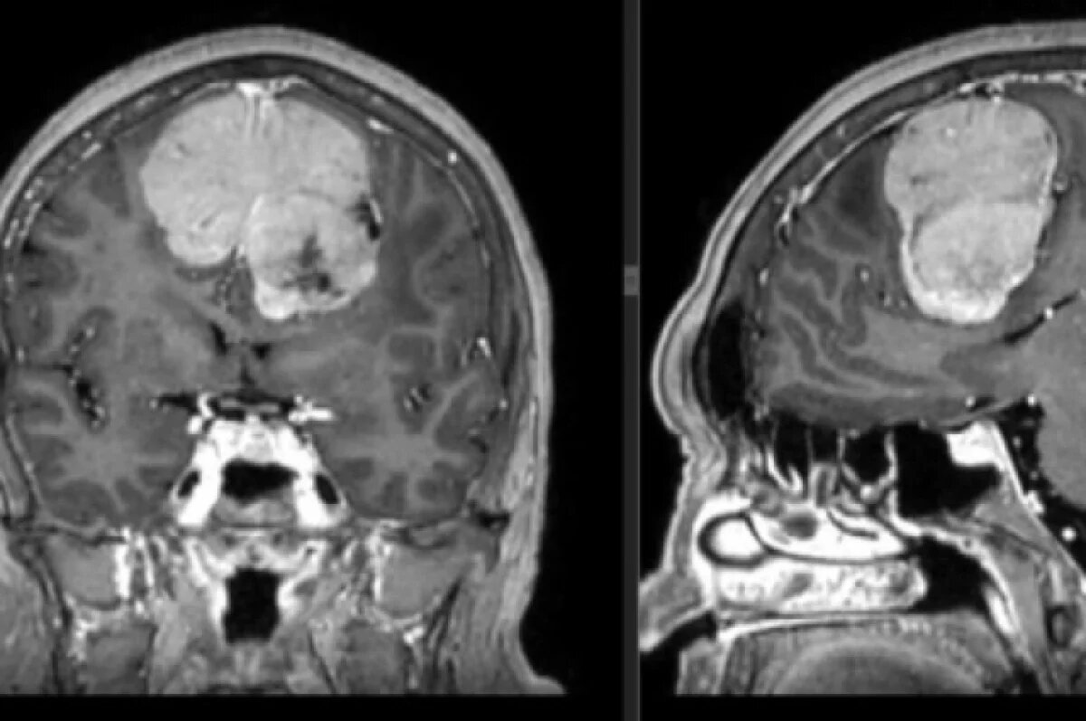    Опухоль, объёмом 189 куб. см., удалили из головы жительницы Удмуртии