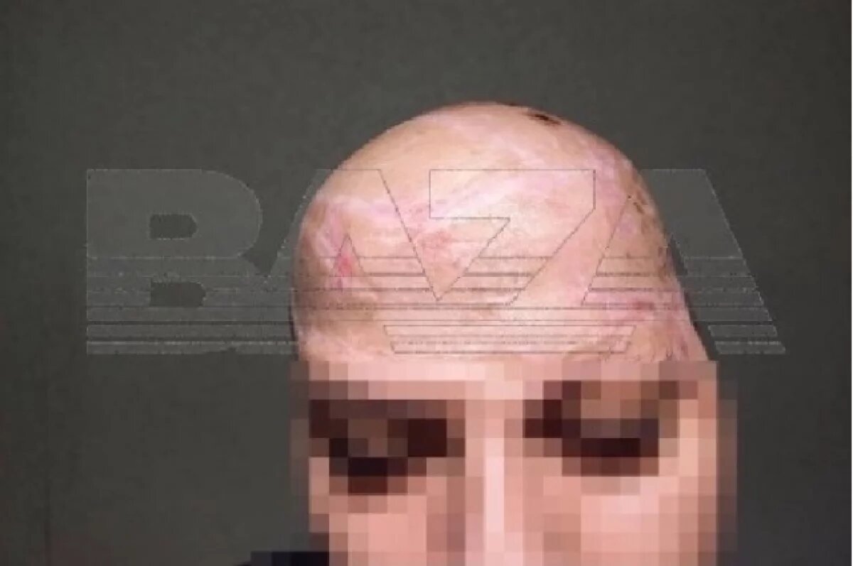    Глава СКР поручил ускорить расследование скальпирования жительницы Самары