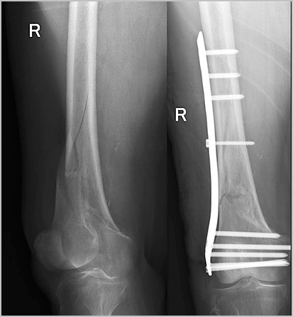 Фиксация отломков 