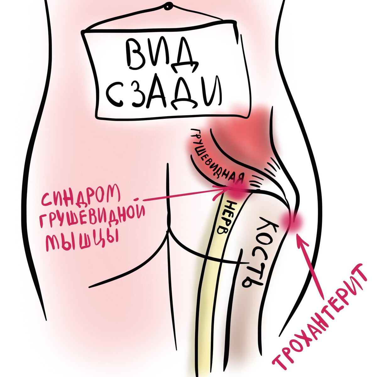 Трохантерит и синдром грушевидной мышцы