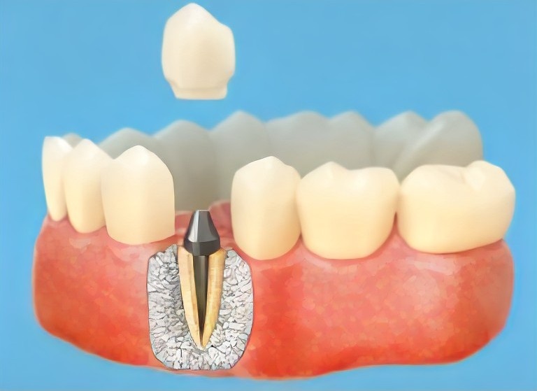 Культевая вкладка под коронку