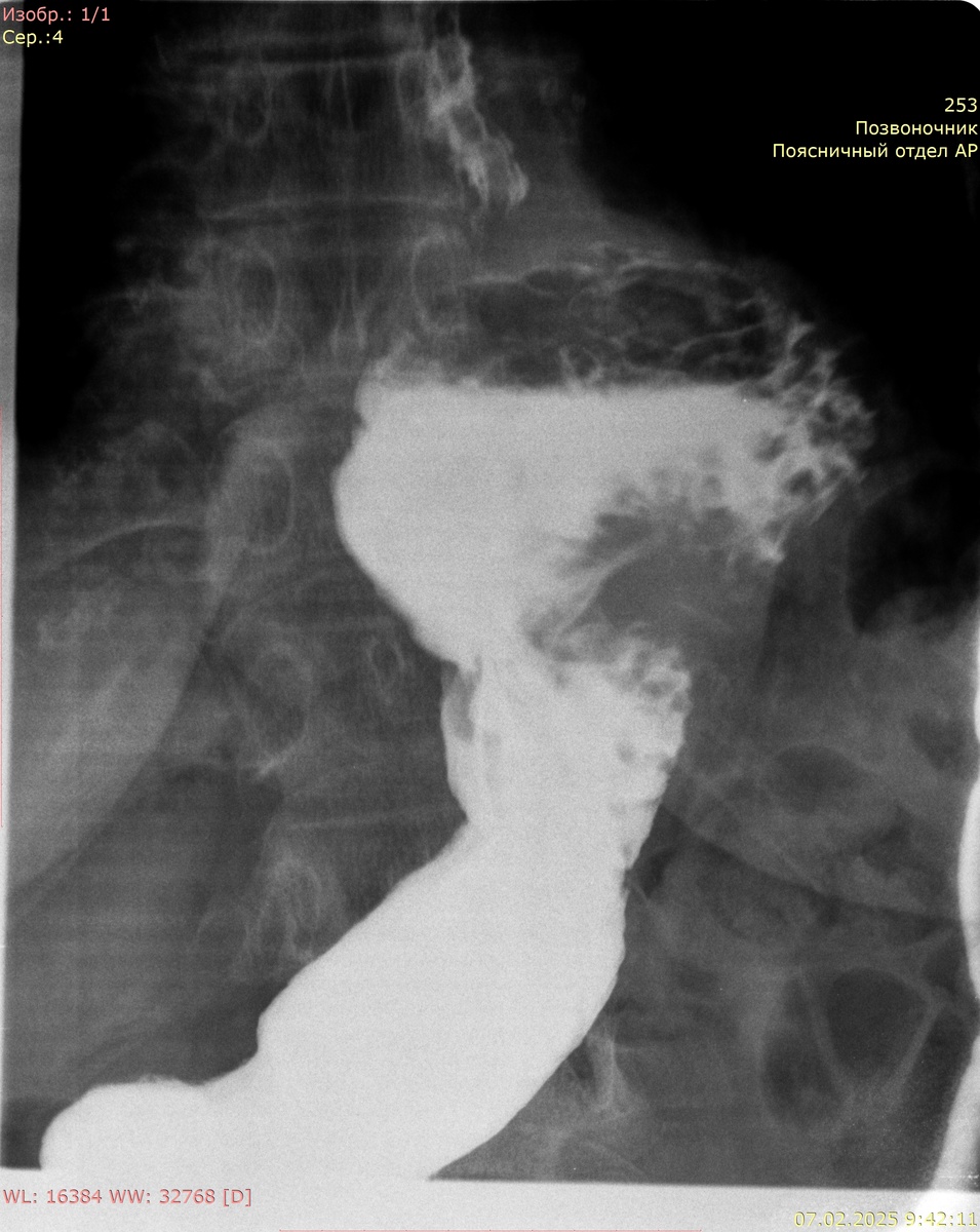 Желудок стоя