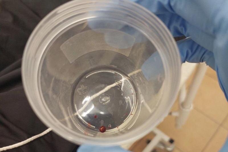    Министерство здравоохранение Челябинской области. Пуля, извлеченная из руки мальчика