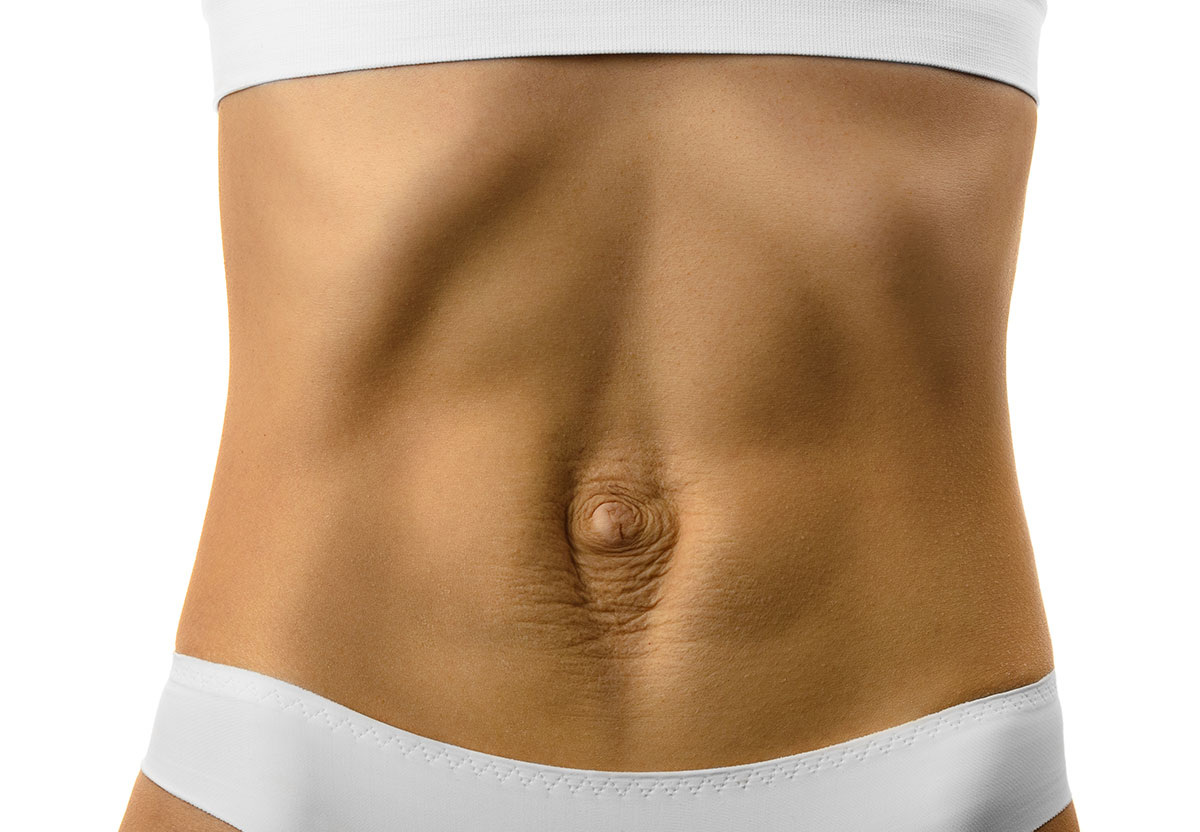 Диастаз прямых мыщц живота