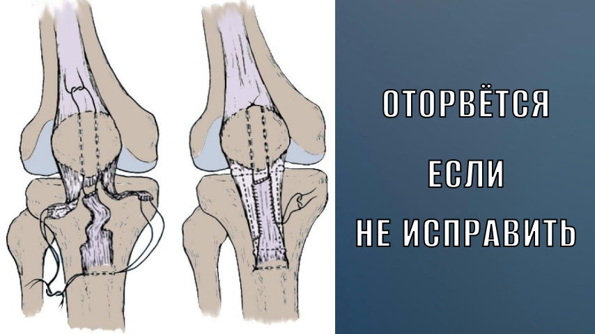 боль ниже коленной чашечки. Боль при длительном сидении, приседании и ходьбе по лестнице.
