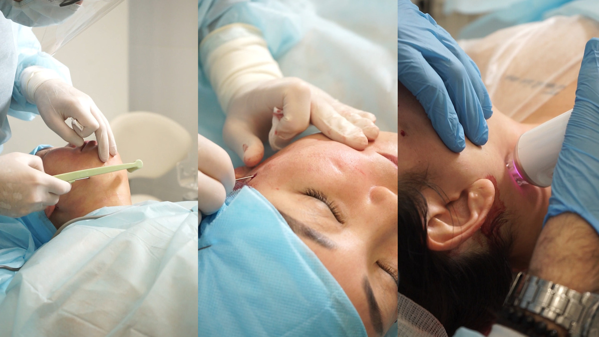 Фейстайт + Морфеус8 + нити