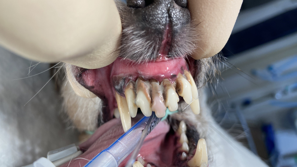 Тяжелое поражение зубов твердыми зубными отложениями. 