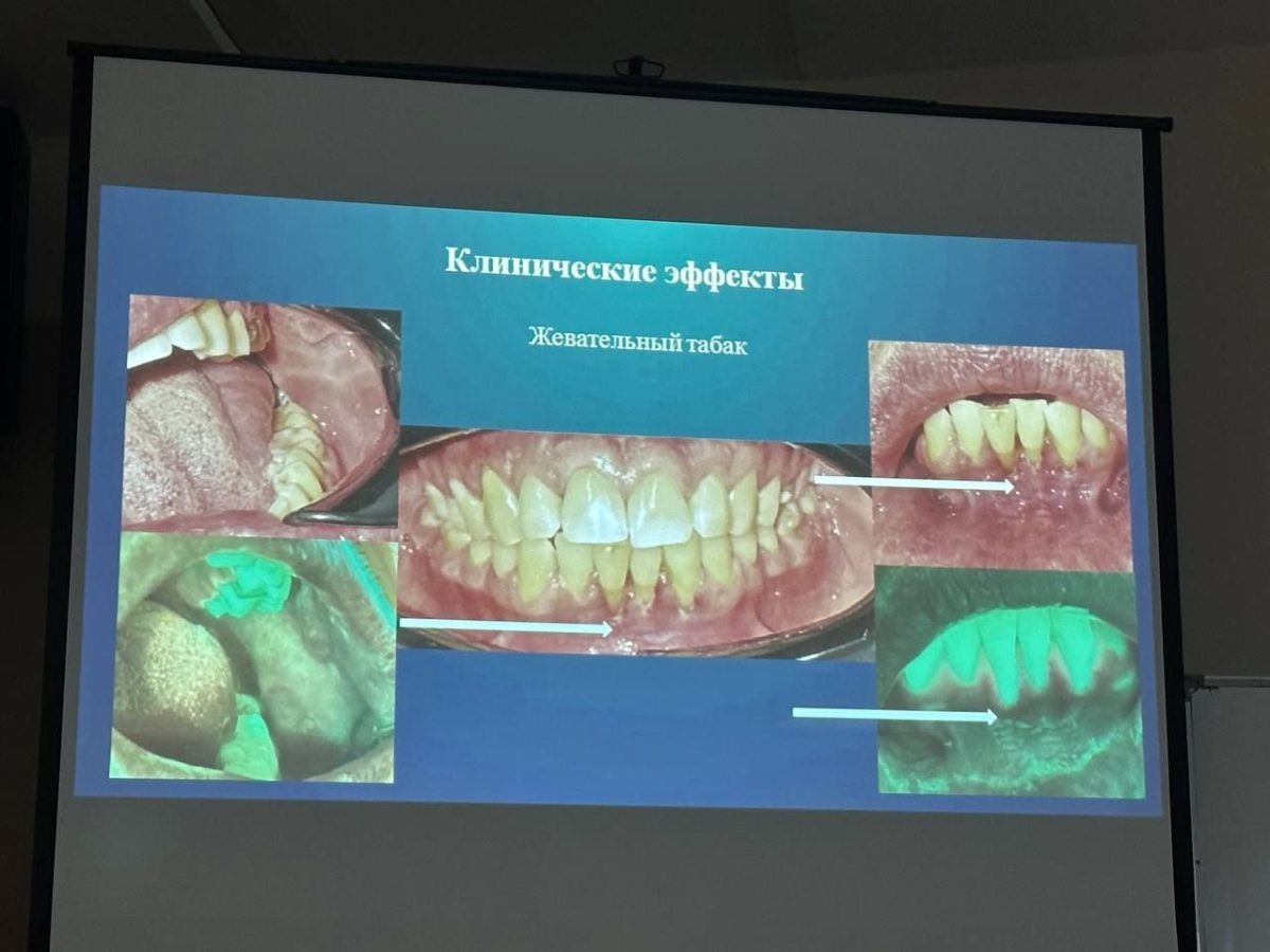   Одной из причин рака полости рта становится вейпинг и табак