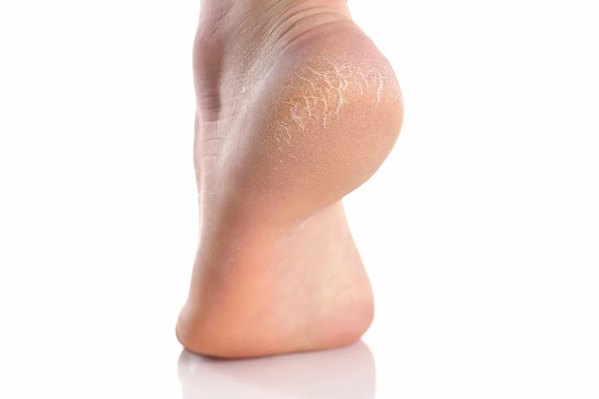 трещины на пятках