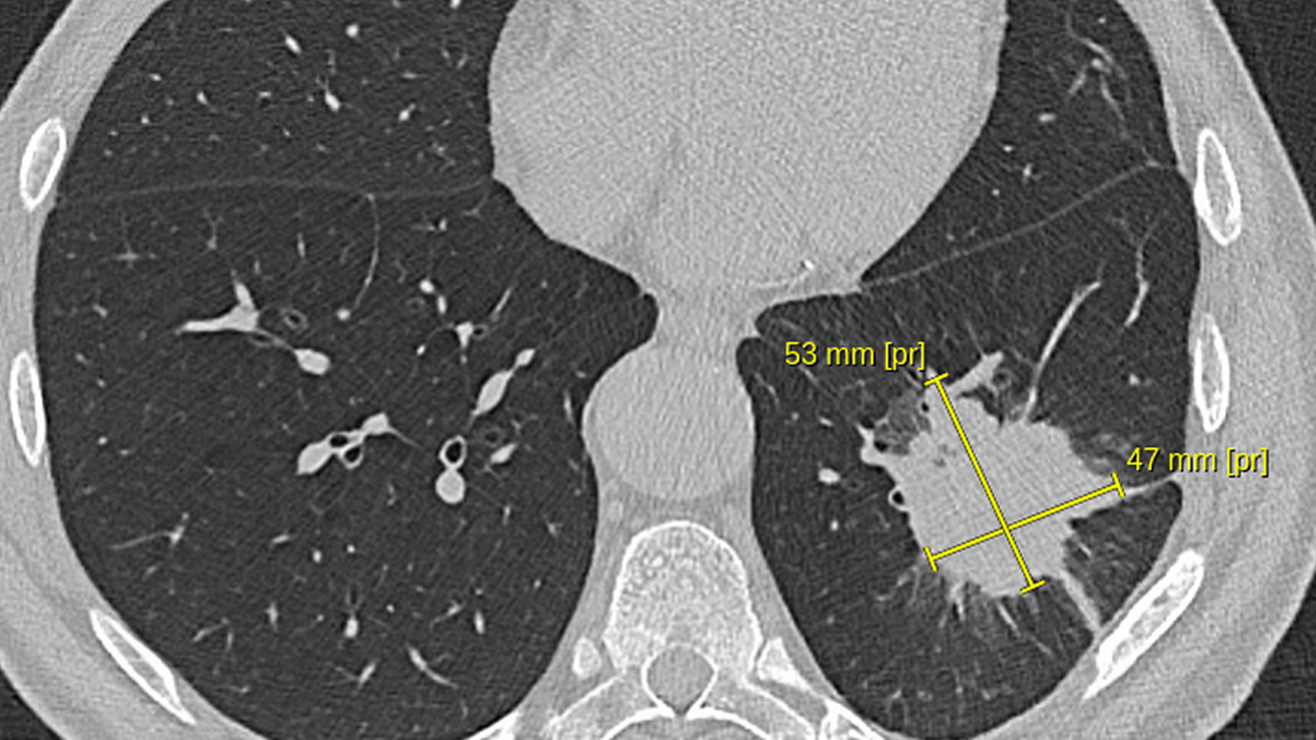 КТ органов грудной клетки при первичной диагностике