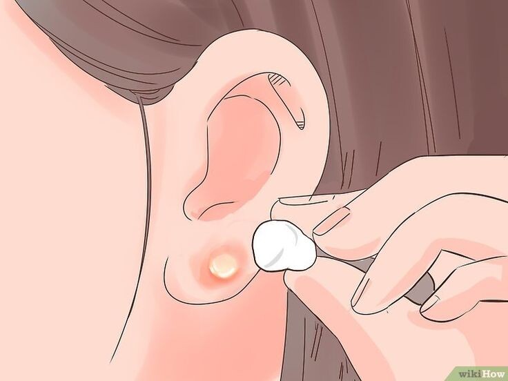 (Пример пустулы) Изображение взято с сайта: https://id.wikihow.com/Mengatasi-Tindikan-Telinga-yang-Terinfeksi