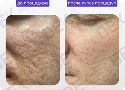 Первоклассные результаты лазерной шлифовки на аппарате SmartXide Punto