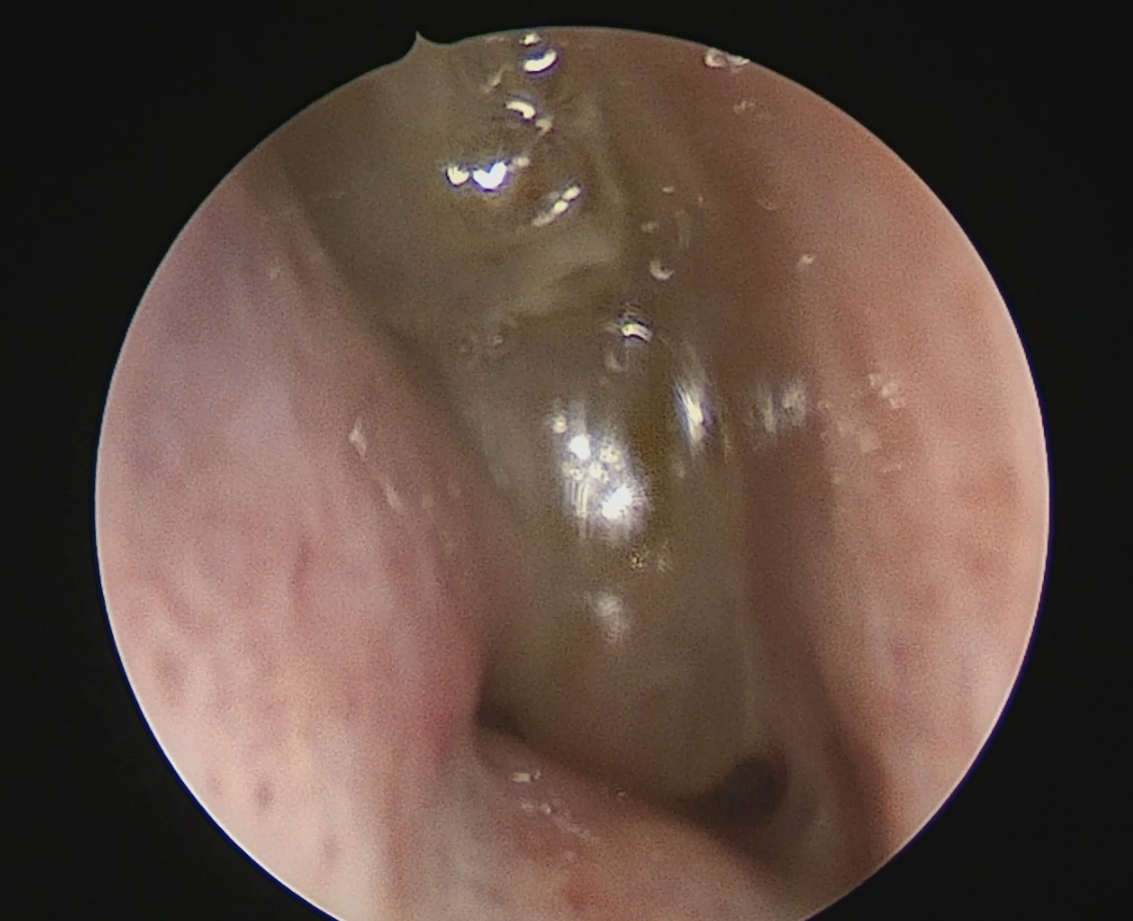 Так выглядят полипы в носу (эндофотография, сделанная автором). Первым признаком появления полипов может быть ухудшение обоняния.