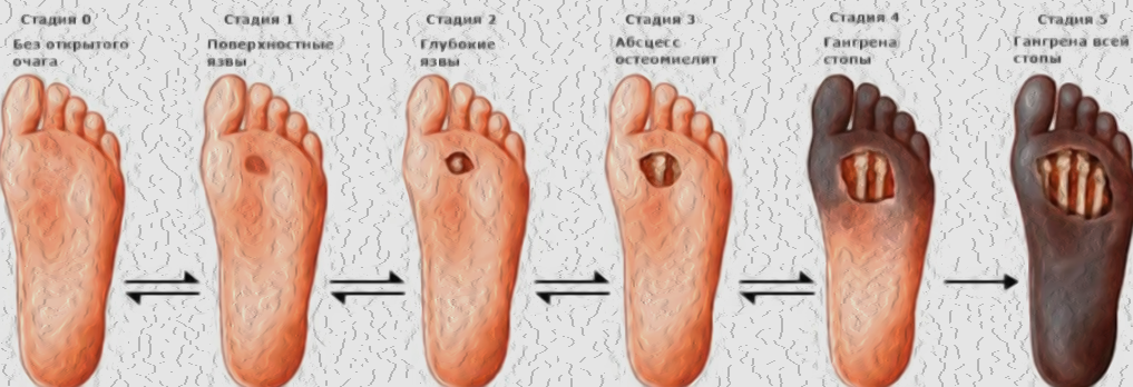 Стадии диабета!