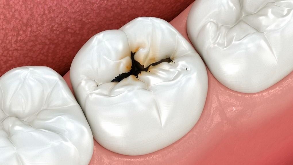 Фиссурный кариес