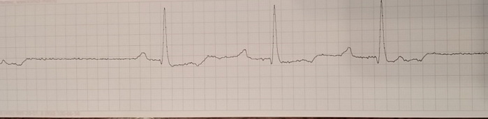 Интервал PQ нарастает от первого к третьему комплексу. Потом блокированная предсердная эстрасистола и пауза 1,7 секунды. Это немного, но при такой кардиограмме можно ждать увеличения степени АВ-блокады.