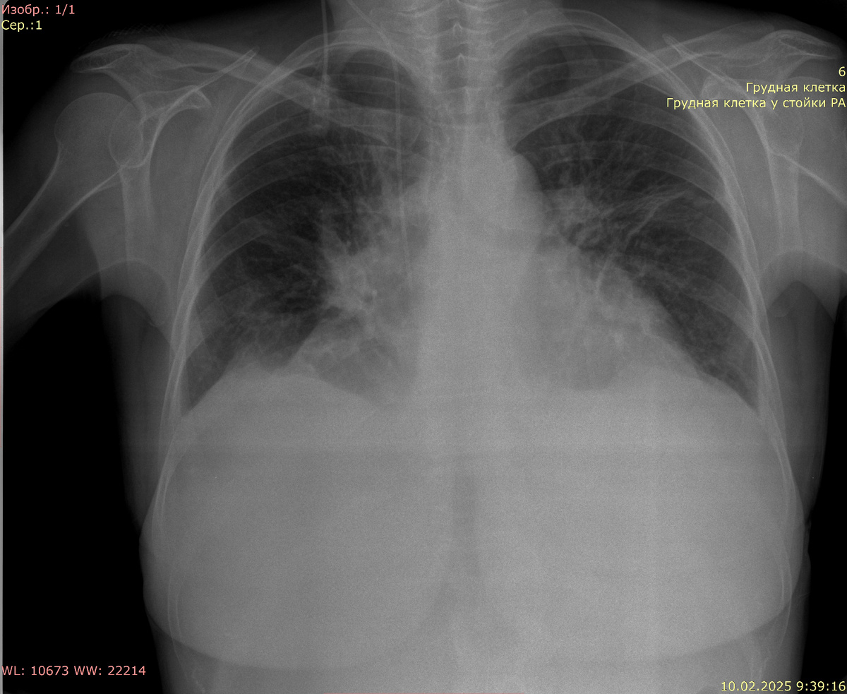 После плевральной пункции