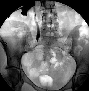 Рис. 1. Антеградная пиелоуретерограмма справа больной В., 41 год. Протяженная стриктура нижней трети правого мочеточника