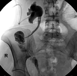 Рис. 2. Антеградная пиелоуретерограмма справа той же больной через 14 дней после операции. Проходимость мочеточника и кишечного трансплантата хорошая
