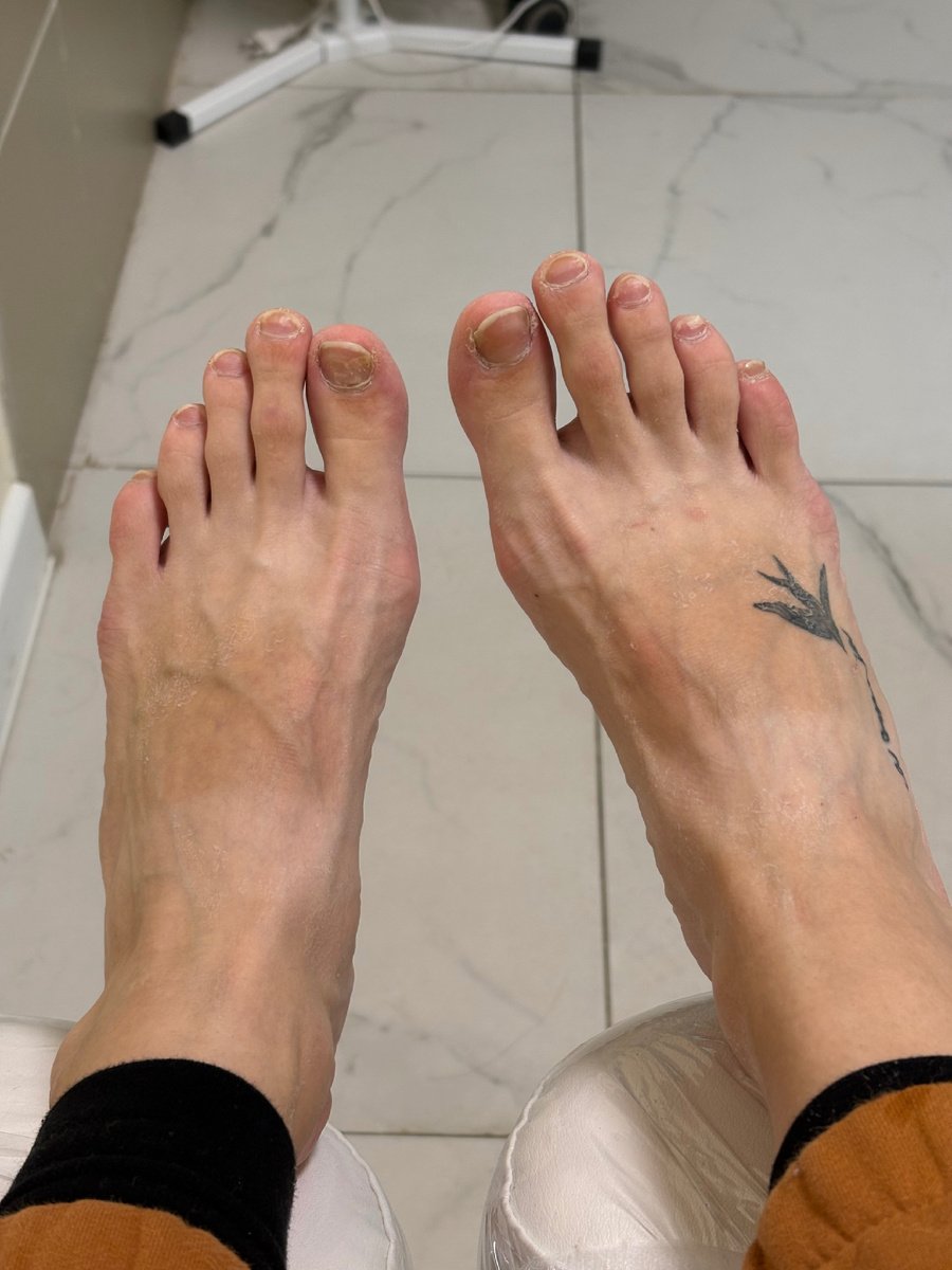 Нашла фото примерно через неделю после процедуры. До педикюра. Ожог задел все ногти. 