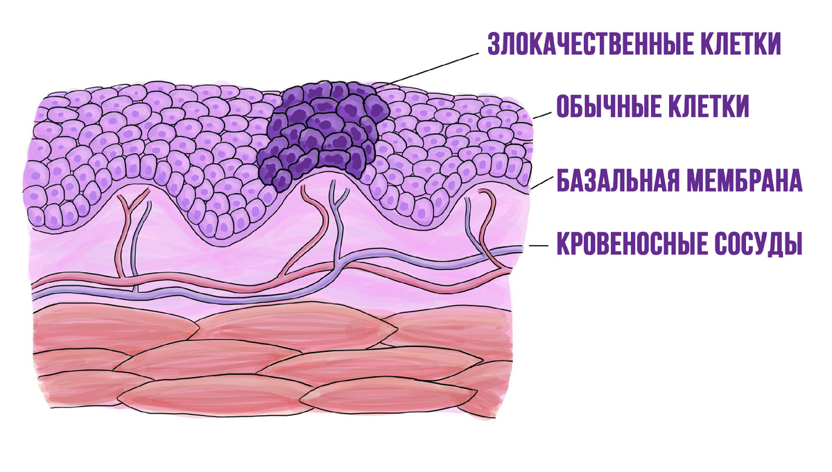 Схема строения рака in situ