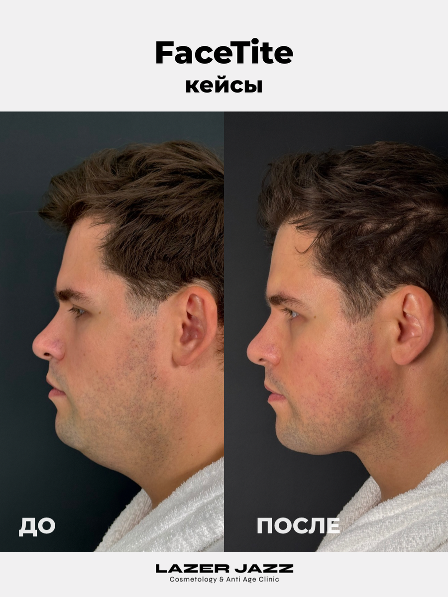 Процедура удаление второго подбородка - FaceTite в клинике LazerJazz