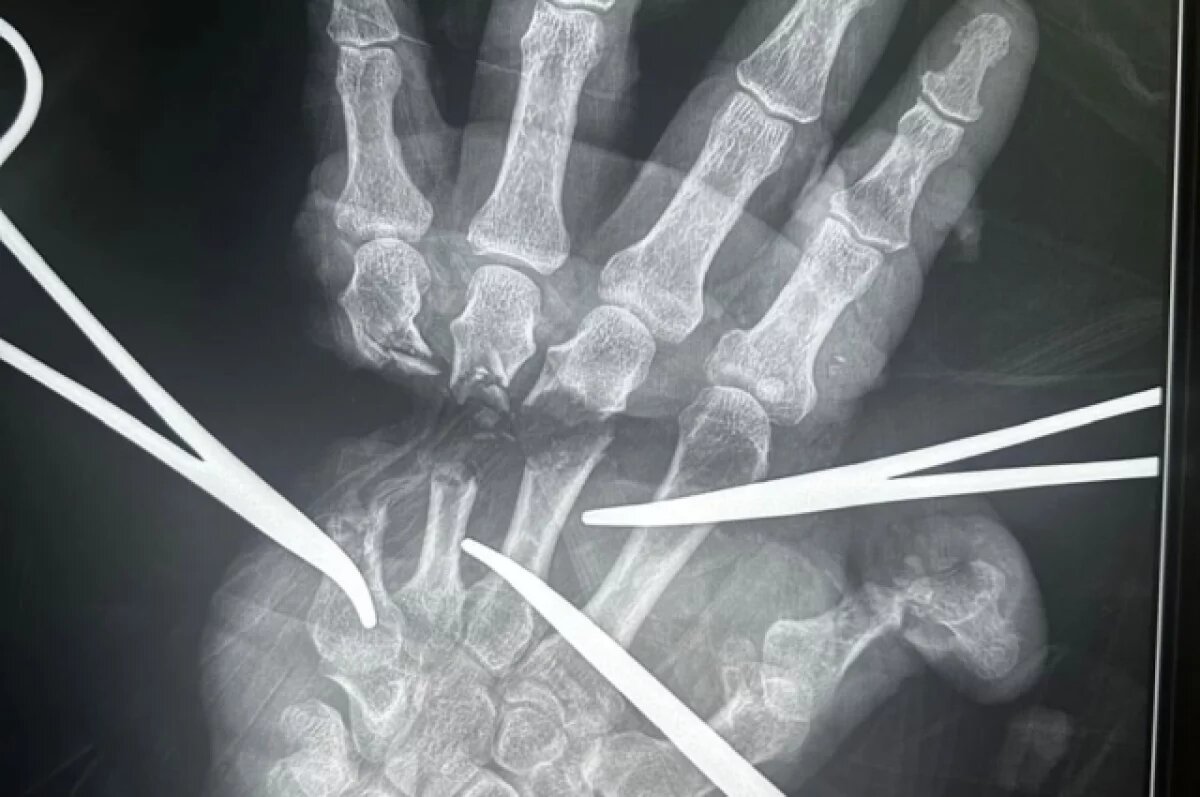    В Новосибирске медики восстановили отрезанную кисть пациента