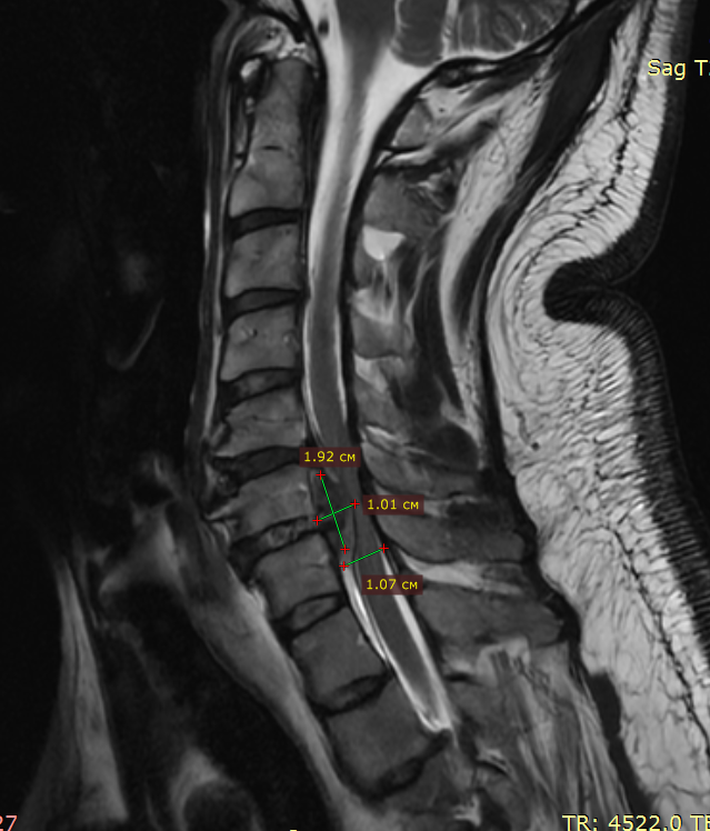 Из-за грыжи межпозвонковый диск полностью мигрировал в позвоночный канал, образовалась гигантская грыжа в шейном отделе на уровне С5-С6 позвонков. МРТ до операции