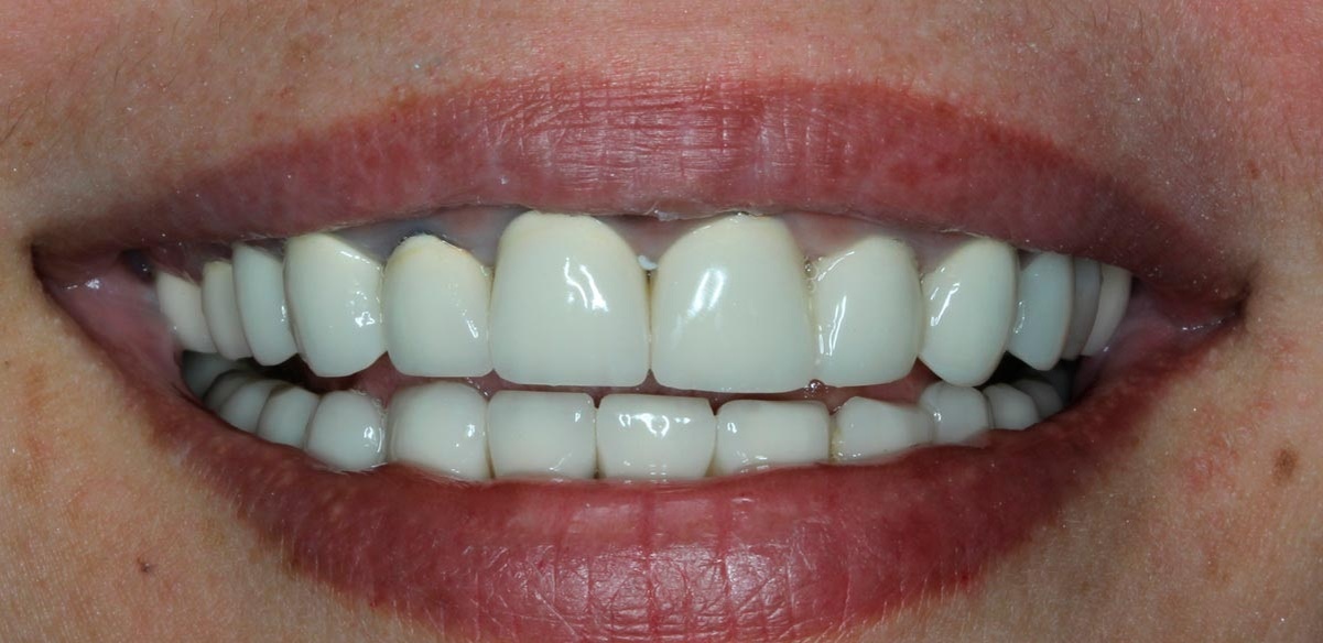 Эти металлокерамические коронки выглядят ненатурально, они массивные и широкие