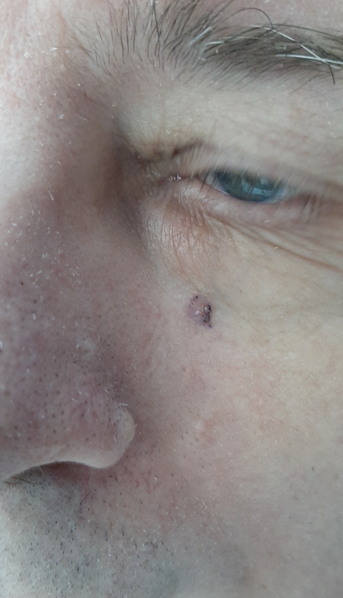 Фото перед операцией, после разметки границы образования синим маркером и обработки антисептиком. Видно, что новообразование представляет собой слегка шелушащееся пятно с несколькими мелкими элементами наподобие корок.