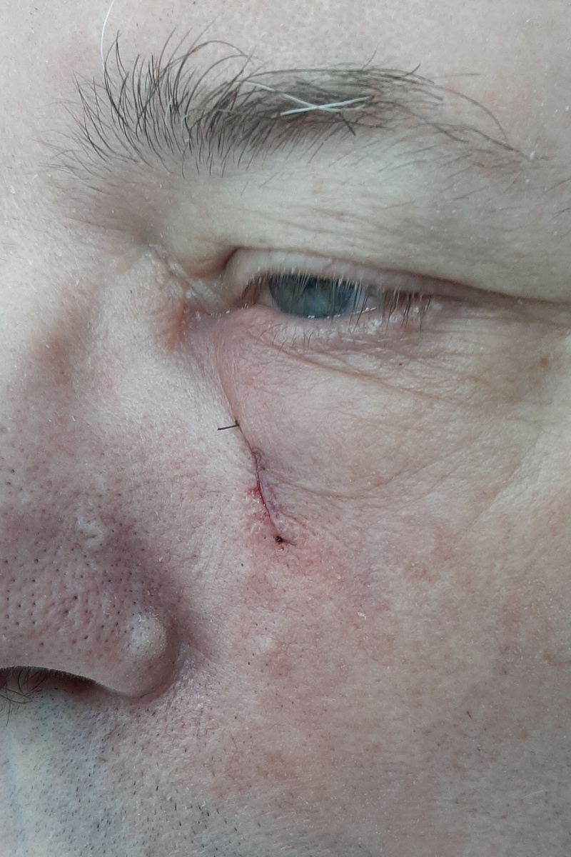 На фото состояние непосредственно после операции. Видна только тонкая линия косметического шва и 2 узла на коже.