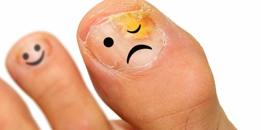 Самые частые ошибки, которые могут испортить Ваши стопы и ногти