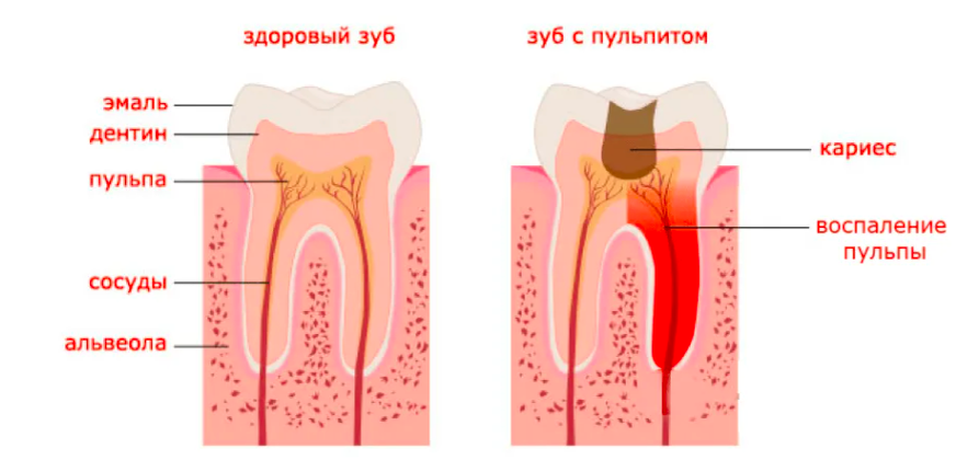 Кариес и пульпит. В чем разница?