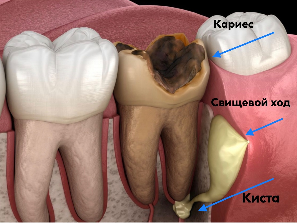Изображение кисты и свищевого хода