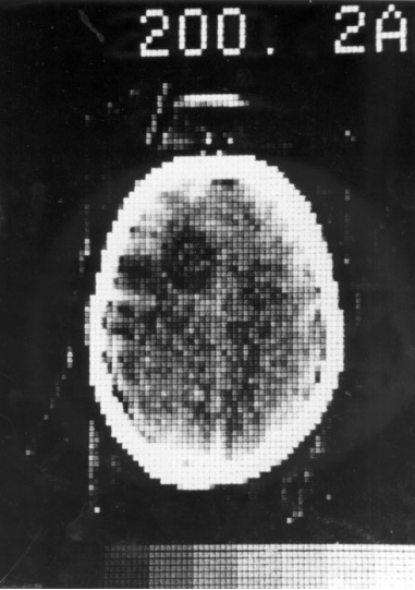Срез, полученный на первом компьютерном томографе в 1972 г. 
