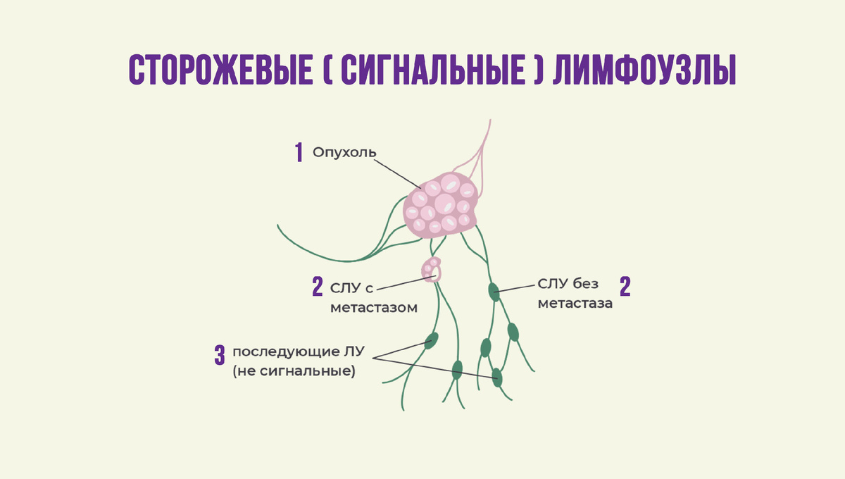 Где располагается сигнальный лимфоузел
