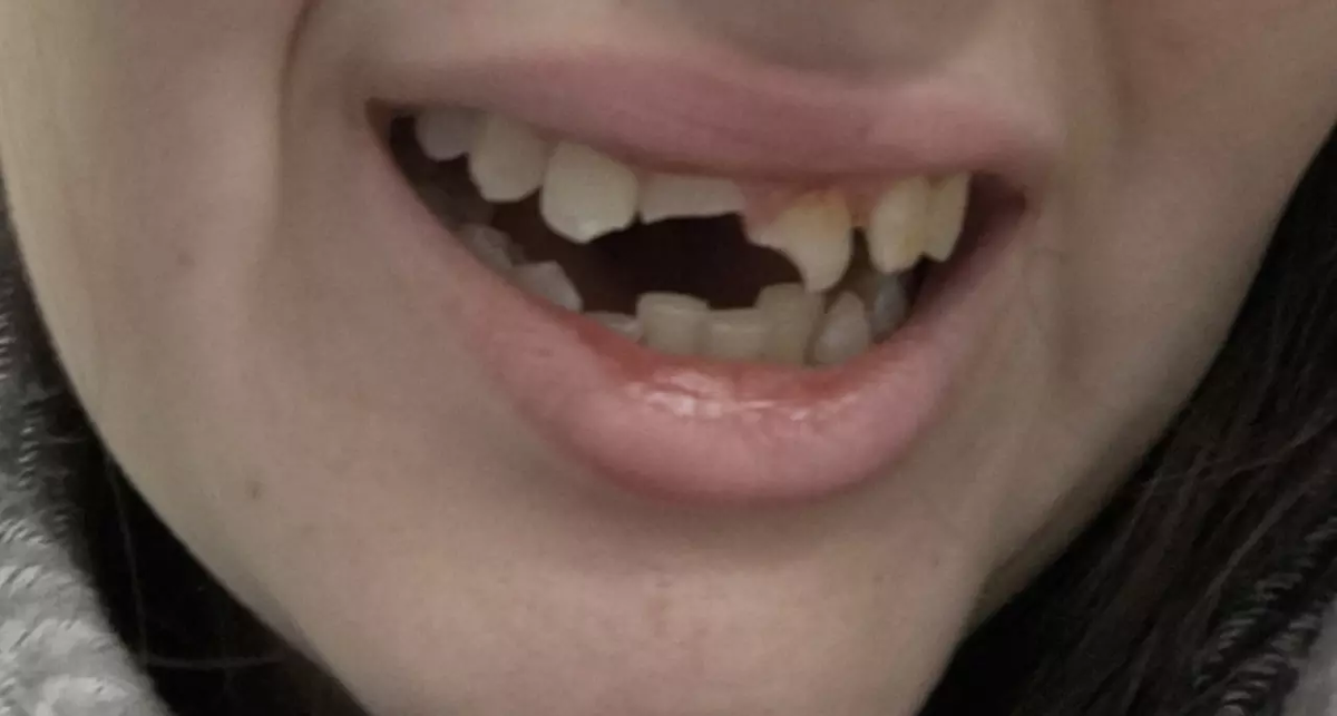 Состояние зубов белгородки после падения на тротуаре. Фото: страница Вячеслава Гладкова
