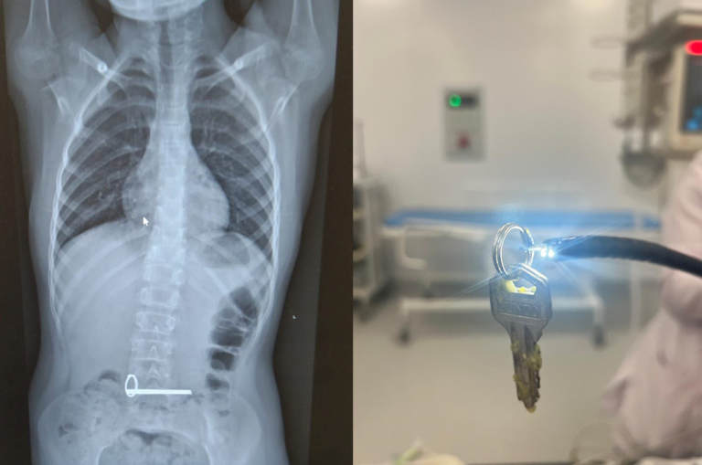    В Оренбуржье восьмилетний ребёнок проглотил связку ключей Оренбуржье