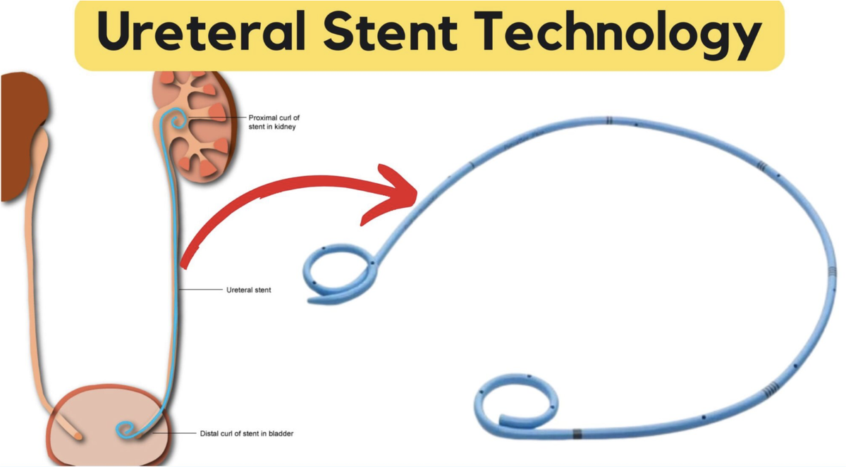 Схематичное расположение стента в мочеточнике